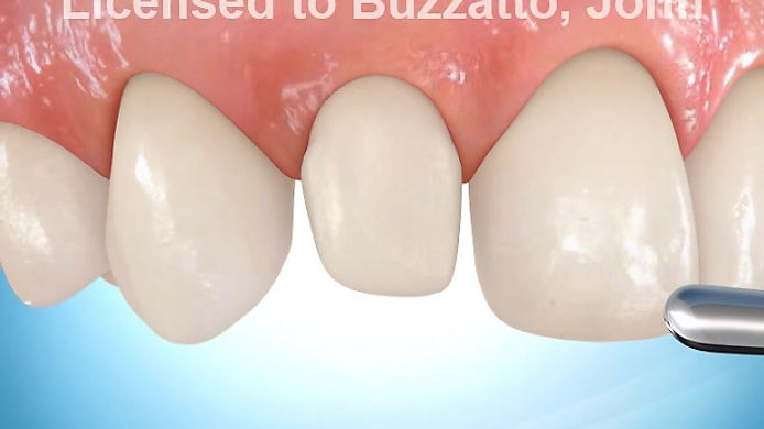 Build-up of Lateral Incisor